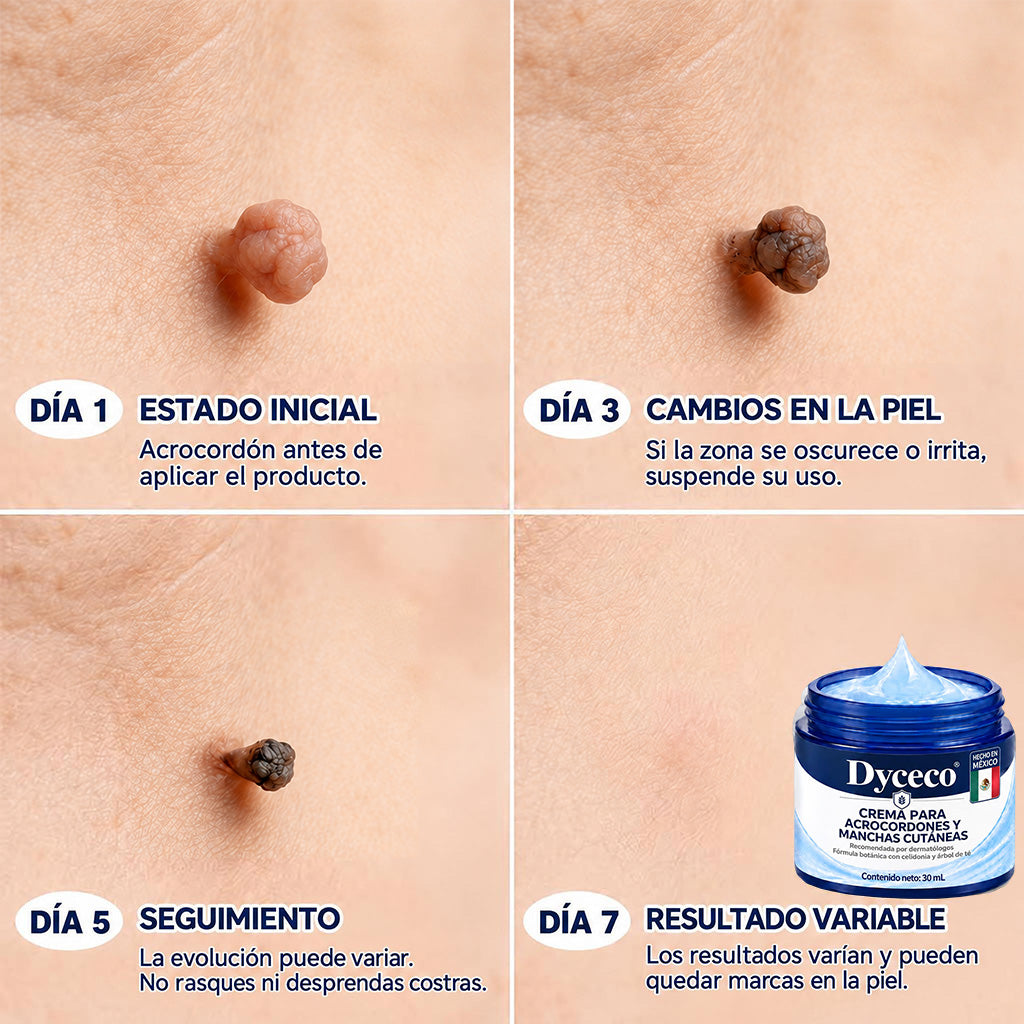 Dyceco® ☁️7 𝒅í𝒂𝒔 𝑪𝒓𝒆𝒎𝒂 𝒃𝒐𝒓𝒓𝒂𝒅𝒐𝒓𝒂 𝒅𝒆 𝒂𝒄𝒓𝒐𝒄𝒐𝒓𝒅𝒐𝒏𝒆𝒔 𝒚 𝒎𝒂𝒏𝒄𝒉𝒂𝒔 (𝑭ó𝒓𝒎𝒖𝒍𝒂 𝑰𝒏𝒄𝒐𝒍𝒐𝒓𝒂 𝒚 𝑺𝒊𝒏 𝑫𝒐𝒍𝒐𝒓)
